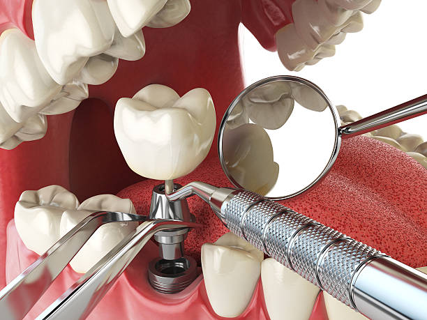 Best Same-Day Emergency Dentist in Mcmillin, WA